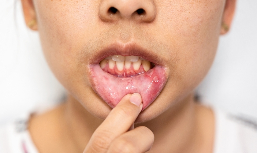 Dealing with Canker Sores