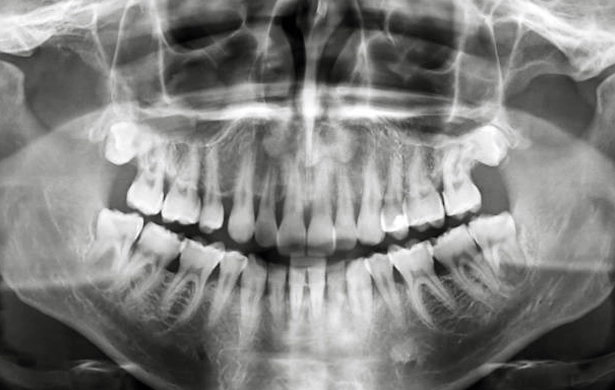 Panoramic X-Ray