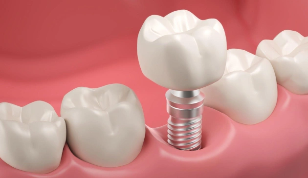 dental implants treatment Waco