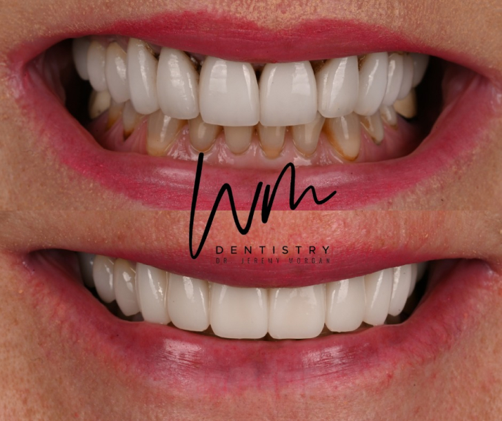 Before and After Smile Makeover Treatment in Waco