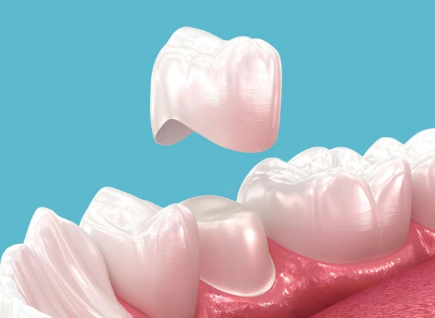 Tooth with a dental crown placed by WM Dentistry