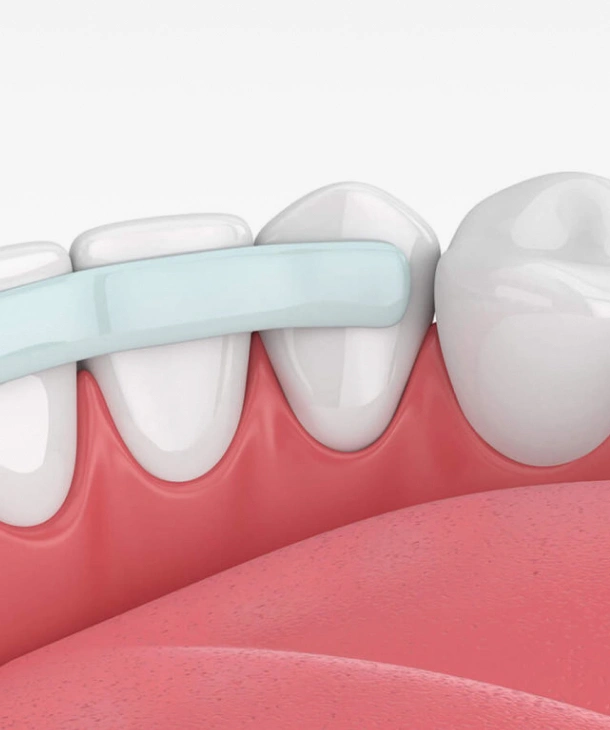 Detailed View of Dental Bonding Treatment at Waco Office